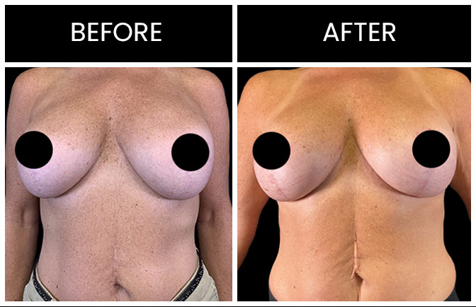 Breast Implant Replacement Results Atlanta